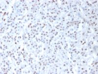 FFPE human mesothelioma sections stained with 100 ul anti-Wilms Tumor 1 (clone 6F-H2) at 1:200. HIER epitope retrieval prior to staining was performed in 10mM Citrate, pH 6.0.